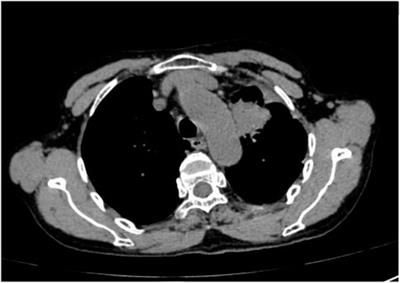 Case report: Treatment with ensartinib shows good response to SQSTM1-ALK fusion in lung adenocarcinoma